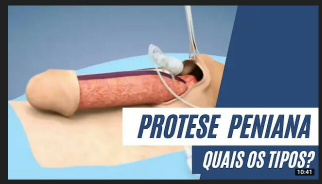 Prótese peniana.png